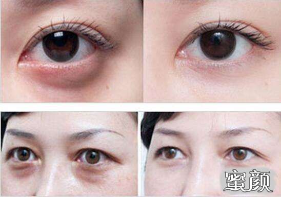 科技揭秘，最新去眼袋最佳方法，重塑眼部美麗新篇章！