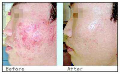 激光祛疤價格詳解，深度解析與觀點闡述