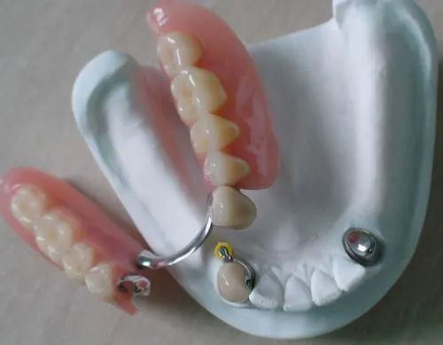 關于活動假牙價格的探討與解析