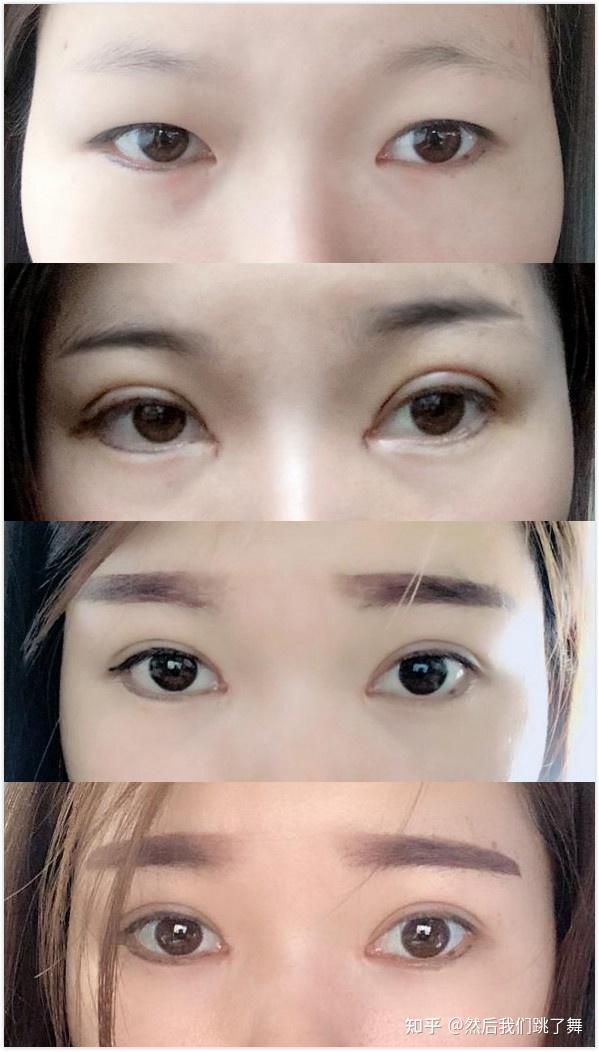 雙眼皮新技術(shù)揭秘，小明的魔法雙眼皮之旅